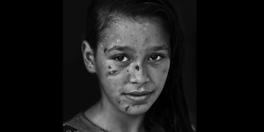 foto van het jonge meisje Dalia Khalifa, getroffen door Israëlisch shrapnel